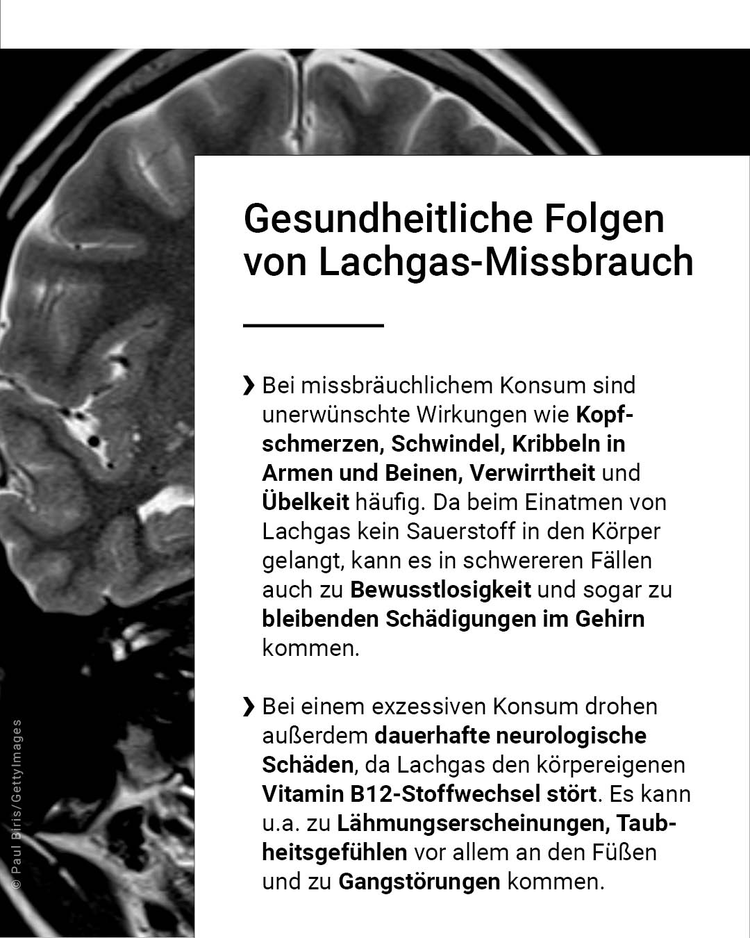 Hinweis - Der folgende Text wurde automatisch generiert: Schwarzweiß-Bild eines MRT-Aufnahme vom Kopf. Es zeigt mögliche Folgen von Lachgasmissbrauch.